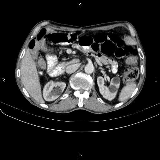 Ampullary adenocarcinoma (Radiopaedia 86093-102033 B 61).jpg