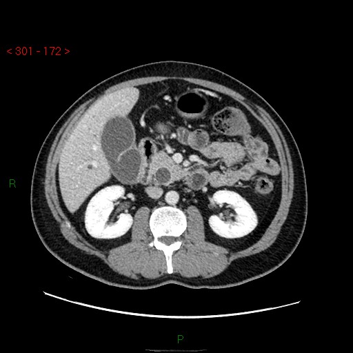 Ampullary carcinoma (Radiopaedia 56396-63056 C 42).jpg