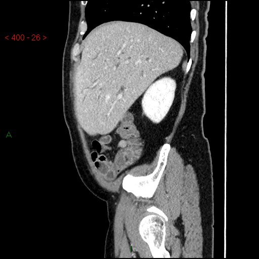 Ampullary carcinoma (Radiopaedia 56396-63056 D 25).jpg