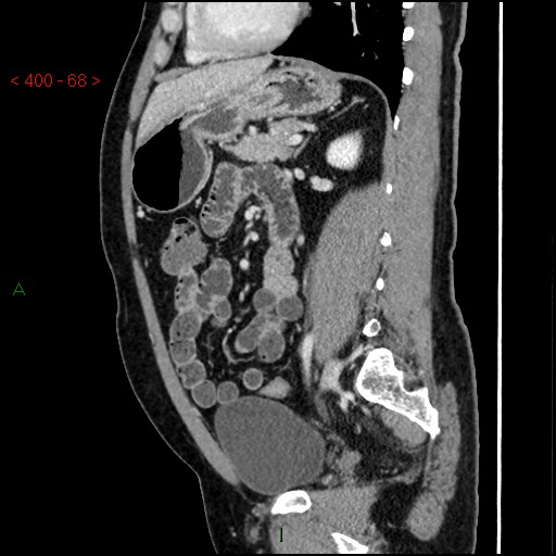 Ampullary carcinoma (Radiopaedia 56396-63056 D 67).jpg
