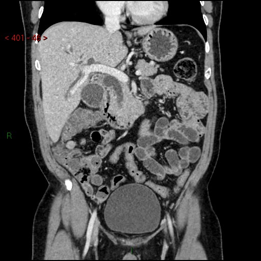 Ampullary carcinoma (Radiopaedia 56396-63056 E 45).jpg