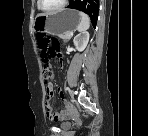 Ampullary tumor (Radiopaedia 60333-67998 C 40).jpg