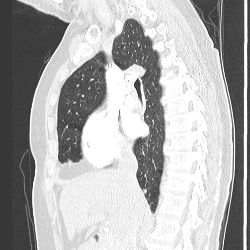 File:Amyloidosis - bronchial and diffuse nodular pulmonary involvement (Radiopaedia 60156-67745 Sagittal lung window 39).jpg
