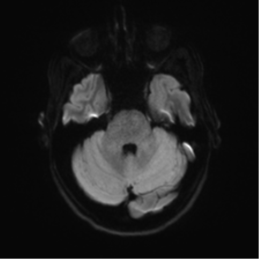 Anaplastic astrocytoma IDH mutant (Radiopaedia 50046-55341 Axial DWI 35).png