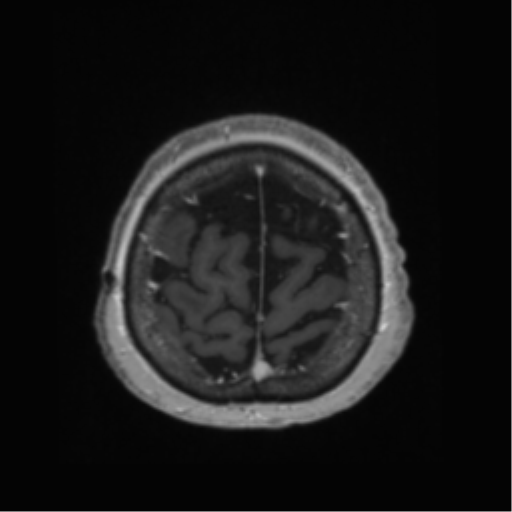 Anaplastic astrocytoma IDH wild-type (pseudoprogression) (Radiopaedia 42209-45278 Axial T1 C+ 134).png