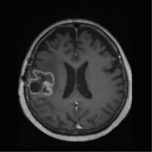 File:Anaplastic astrocytoma IDH wild-type (pseudoprogression) (Radiopaedia 42209-45278 Axial T1 C+ 97).png