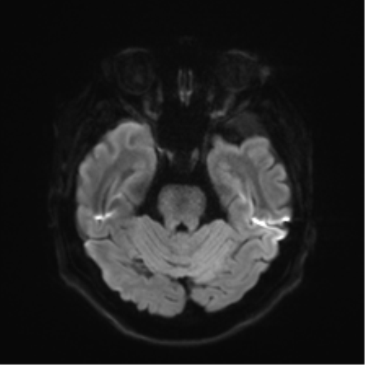 Anaplastic astrocytoma IDH wild-type (pseudoprogression) (Radiopaedia 42209-45279 Axial DWI 36).png