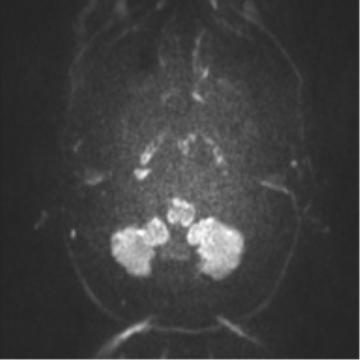 Anaplastic oligodendroglioma (Radiopaedia 37667-39563 Axial DWI 43).png