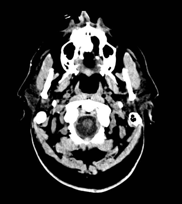 Anaplastic oligodendroglioma (Radiopaedia 79571-92758 Axial non-contrast 2).jpg