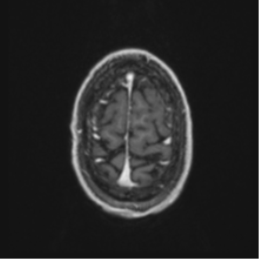 Anaplastic oligodendroglioma with skull fracture (Radiopaedia 74831-85845 Axial T1 C+ fat sat 60).png