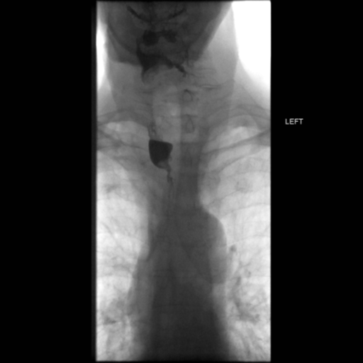 File:Anastomotic stricture post Ivor Lewis esophagectomy (Radiopaedia 47937-52715 Frontal 5).png