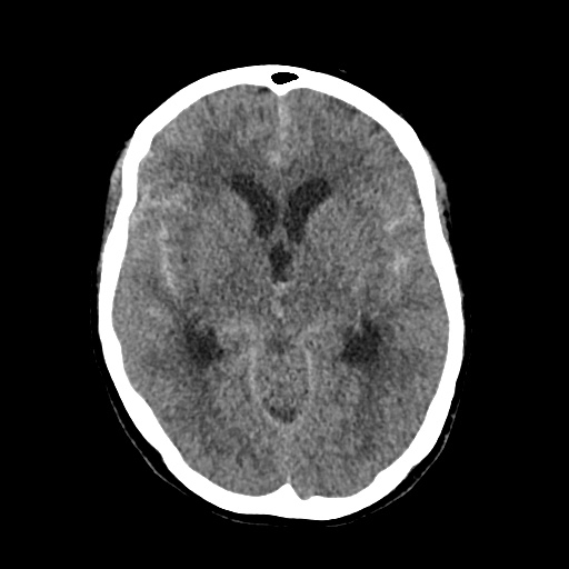 File:Aneursym related subarachnoid hemorrhage with hydrocephalus (Radiopaedia 45105-49083 Axial non-contrast 21).jpg