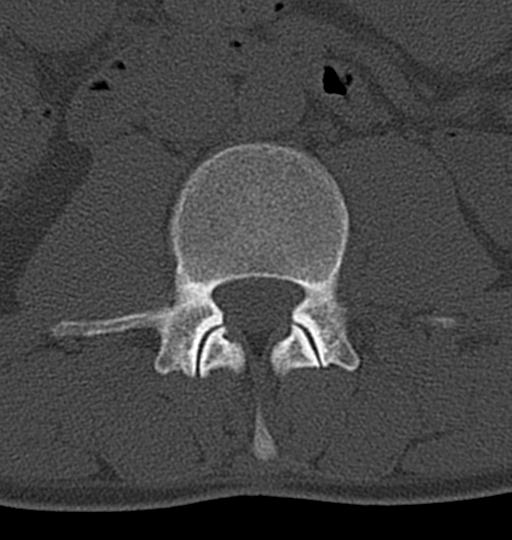 Aneurysmal bone cyst T11 (Radiopaedia 29294-29721 Axial bone window 85).jpg