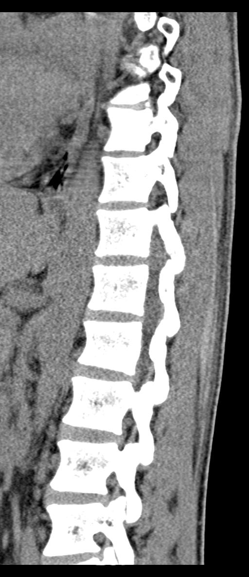 Aneurysmal bone cyst T11 (Radiopaedia 29294-29721 E 32).jpg