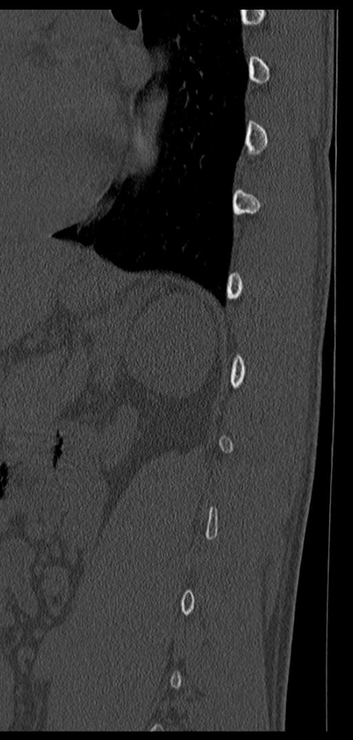 Aneurysmal bone cyst T11 (Radiopaedia 29294-29721 Sagittal bone window 16).jpg