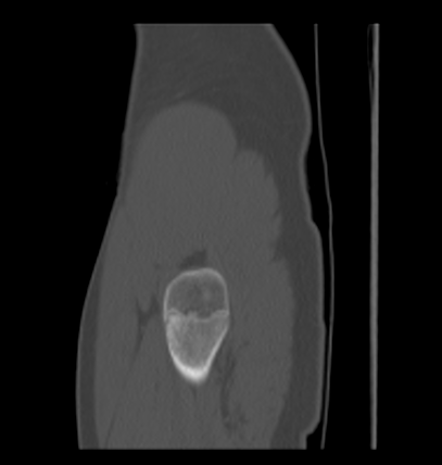 Aneurysmal bone cyst of ischium (Radiopaedia 25957-26094 Sagittal bone window 69).png