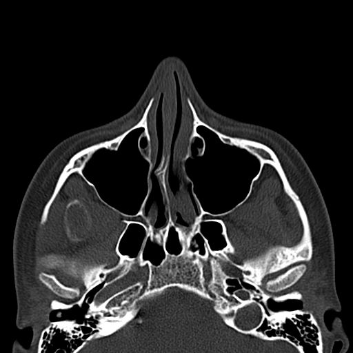 Aneurysmal bone cyst of the mandible (Radiopaedia 43280-46601 Axial bone window 76).jpg