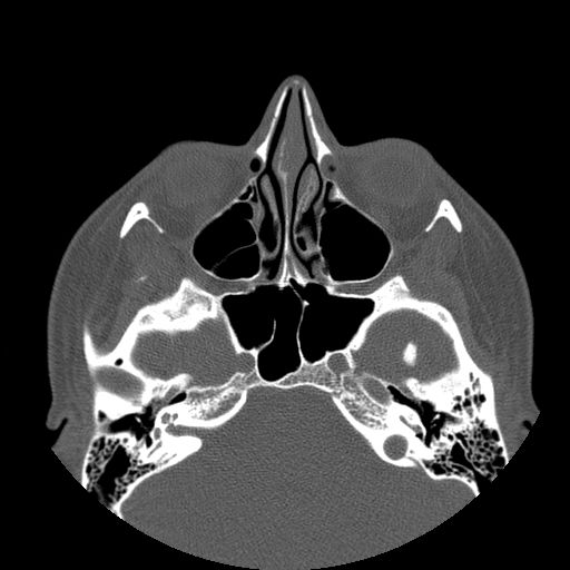 Aneurysmal bone cyst of the mandible (Radiopaedia 43280-46823 Axial bone window 152).jpg