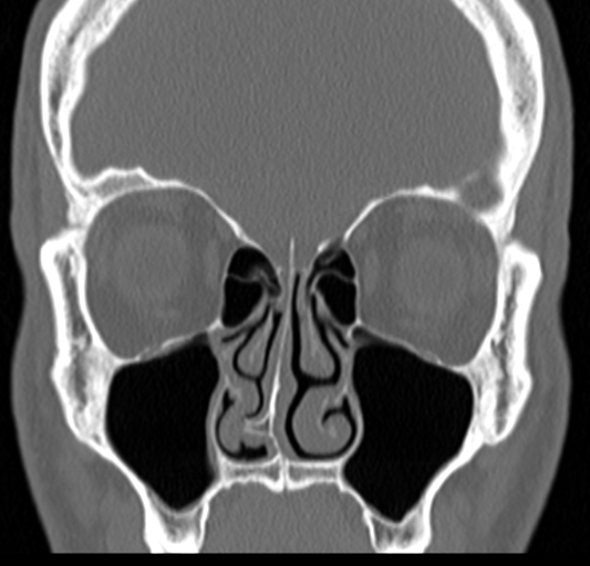 Angular epidermoid cyst (Radiopaedia 46908-51439 Coronal bone window 28).png