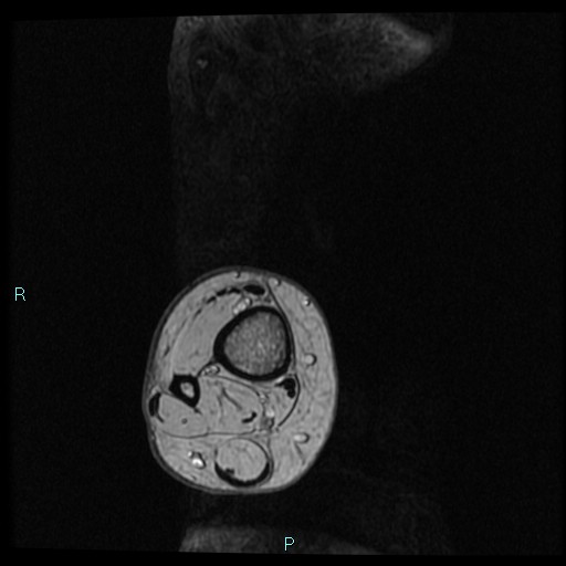 Ankle ganglion cyst (Radiopaedia 62809-71162 Axial Gradient Echo 107).jpg