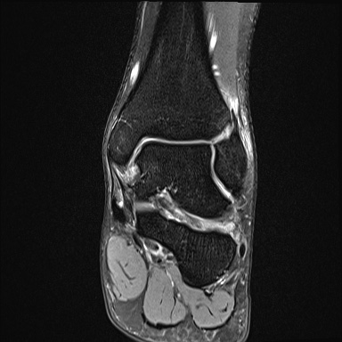 Ankle syndesmotic injury (Radiopaedia 69066-78837 Coronal PD fat sat 32).jpg