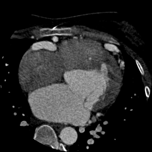 Anomalous left coronary artery from the pulmonary artery (ALCAPA) (Radiopaedia 40884-43586 A 38).jpg