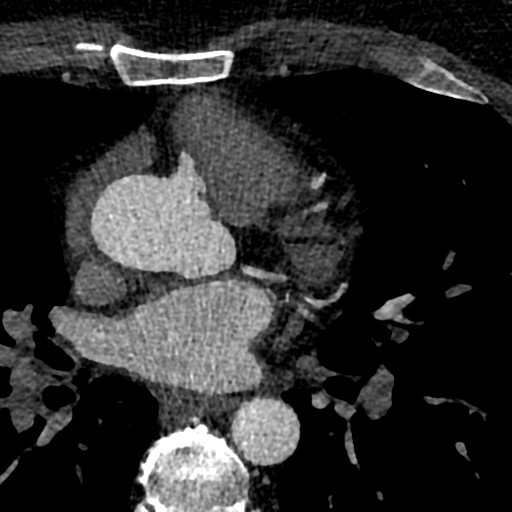 File:Anomalous origin of the left coronary artery with malignant course (Radiopaedia 77842-90126 C 46).jpeg