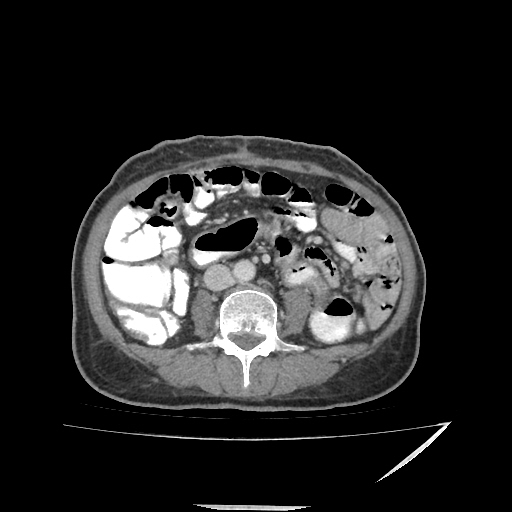 Anorectal carcinoma (Radiopaedia 44413-48064 A 30).jpg