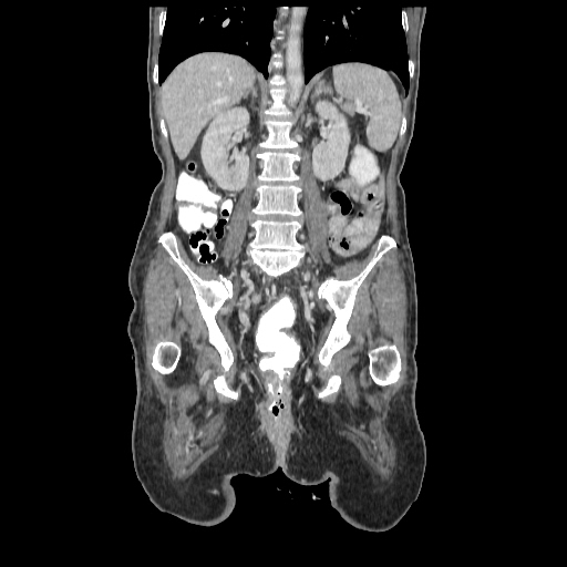 Anorectal carcinoma (Radiopaedia 44413-48064 B 54).jpg