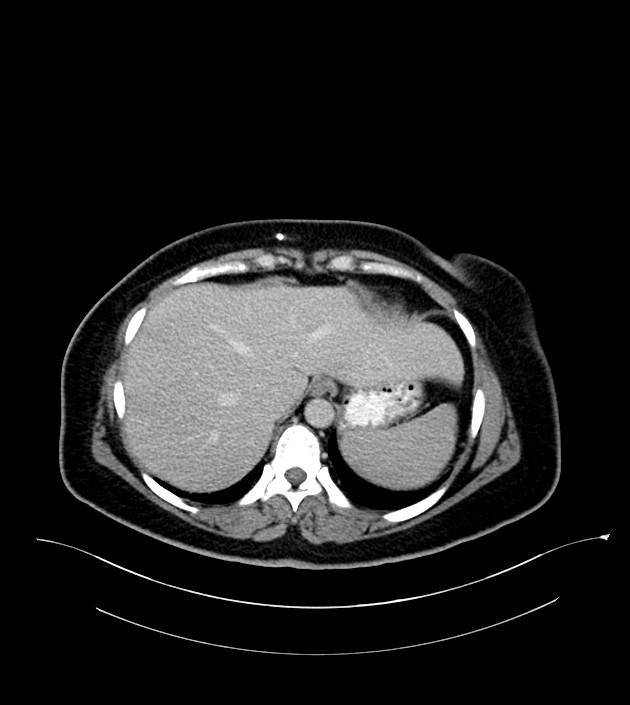 Anterior abdominal wall CSF pseudocyst (CSFoma) (Radiopaedia 79453-92571 A 18).jpg