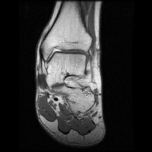 File:Anterior calcaneal process fracture (Radiopaedia 74654-85611 Coronal T1 9).jpg