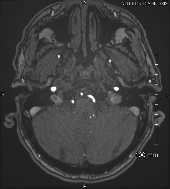 Anterior cerebral artery aneurysm (Radiopaedia 80683-94127 Axial MRA 36).jpg