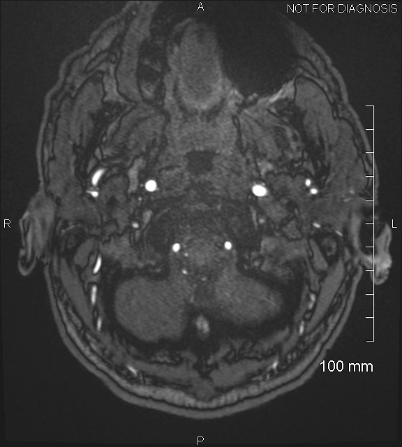 Anterior cerebral artery aneurysm (Radiopaedia 80683-94127 Axial MRA 6).jpg