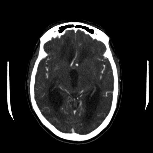 File:Anterior communicating artery aneurysm (Radiopaedia 16633-16335 A 20).jpg