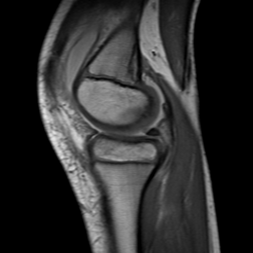 File:Anterior cruciate ligament avulsion fracture (Radiopaedia 24710-24974 Sagittal T1 4).jpg