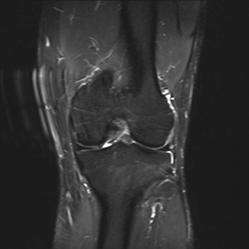 File:Anterior cruciate ligament full thickness tear (Radiopaedia 66268-75467 Coronal STIR 12).jpg