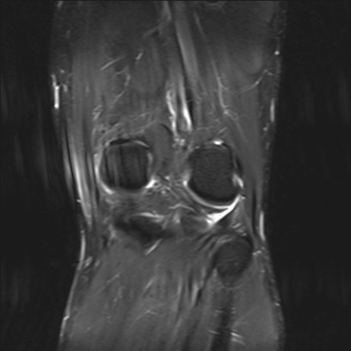 File:Anterior cruciate ligament full thickness tear (Radiopaedia 66268-75467 Coronal STIR 16).jpg