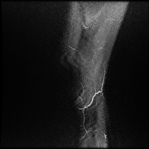File:Anterior cruciate ligament graft tear and bucket-handle tear of medial meniscus (Radiopaedia 75867-87254 Sagittal PD fat sat 28).jpg