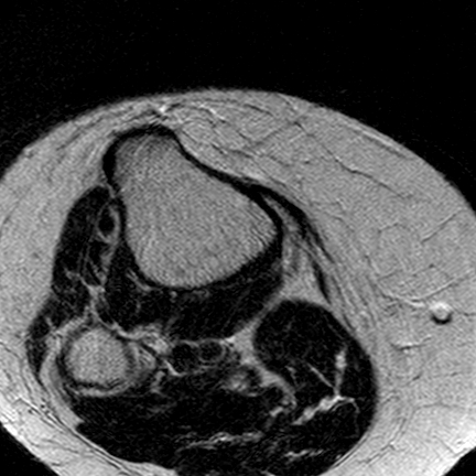 File:Anterior cruciate ligament mucoid degeneration (Radiopaedia 60853-68633 Axial T2 3).jpg