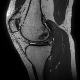 Anterior cruciate ligament rupture and posteromedial corner injury (Radiopaedia 67338-76723 Sagittal PD 67).jpg