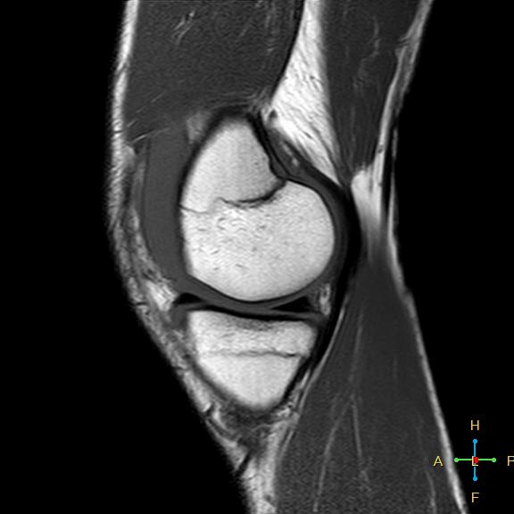 File:Anterior cruciate ligament tear - complete (Radiopaedia 24907-25170 Sagittal T1 14).jpg