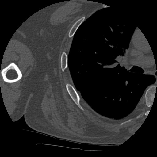 Anterior glenohumeral dislocation with Hill-Sachs lesion (Radiopaedia 62877-71249 Axial bone window 88).jpg