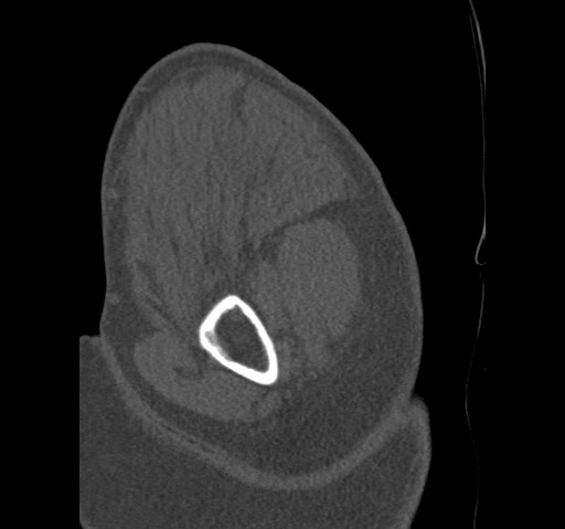 Anterior glenohumeral dislocation with Hill-Sachs lesion (Radiopaedia 62877-71249 Sagittal bone window 14).jpg
