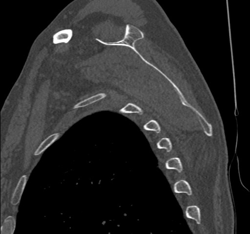 File:Anterior glenohumeral dislocation with Hill-Sachs lesion (Radiopaedia 62877-71249 Sagittal bone window 48).jpg