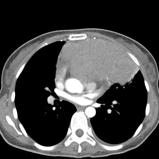 File:Anterior mediastinal lymphoma (Radiopaedia 29556-30061 C 29).jpg