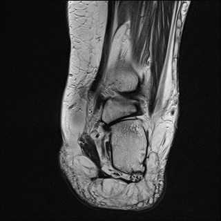 File:Anterior talofibular ligament injury - rupture with soft-tissue impingement (Radiopaedia 38765-40928 Coronal T2 11).jpg