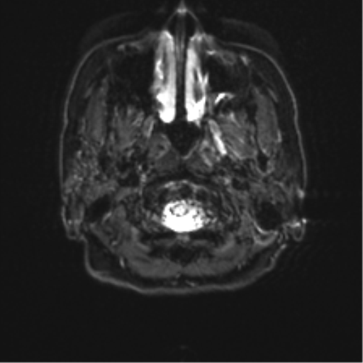Anterior temporal pole cysts (Radiopaedia 46629-51102 Axial DWI 1).png