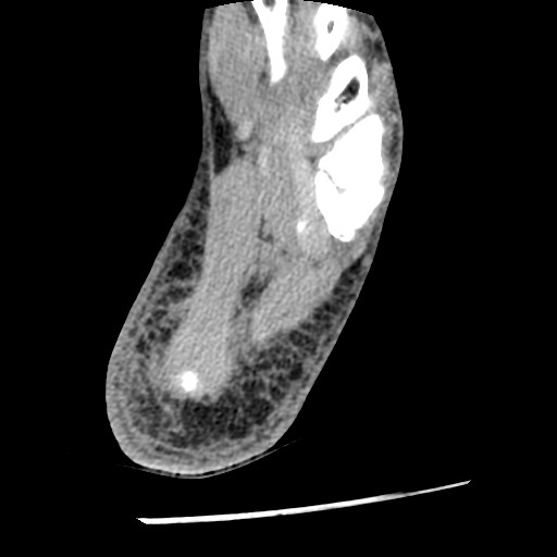 Anterior tibial artery false aneurysm (Radiopaedia 88984-105809 A 224).jpg