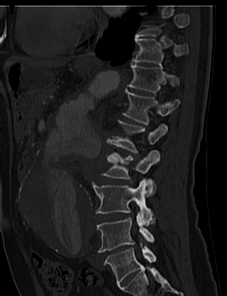 File:Anterior vertebral scalloping (abdominal aortic aneurysm) (Radiopaedia 66744-76067 Sagittal bone window 54).jpg