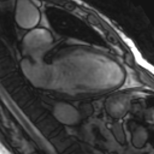 File:Anteroseptal hypokinesia after myocardial infarction (Radiopaedia 15978-15633 2 chamber view SSFE 24).jpg